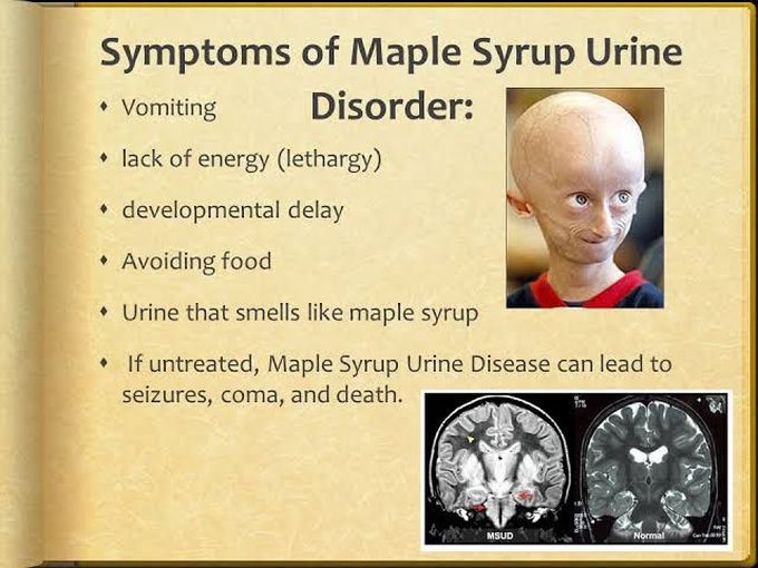 Maple syrup urine disease symptoms