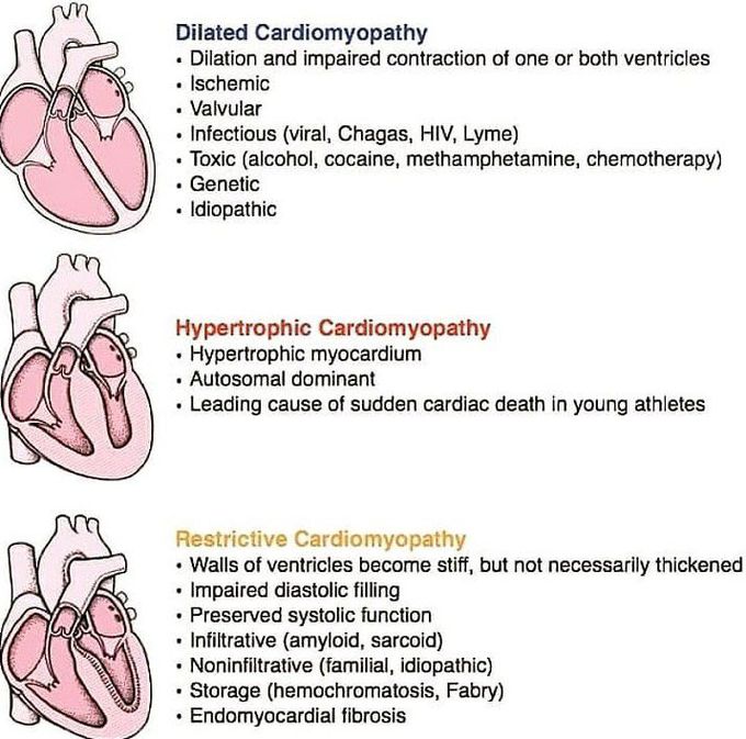Types of cardiomyopathy