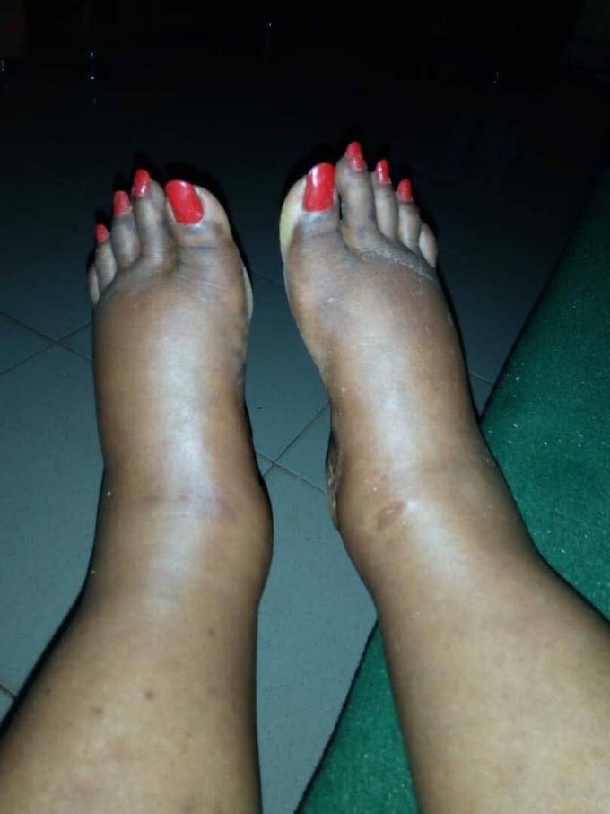 Swollen feet