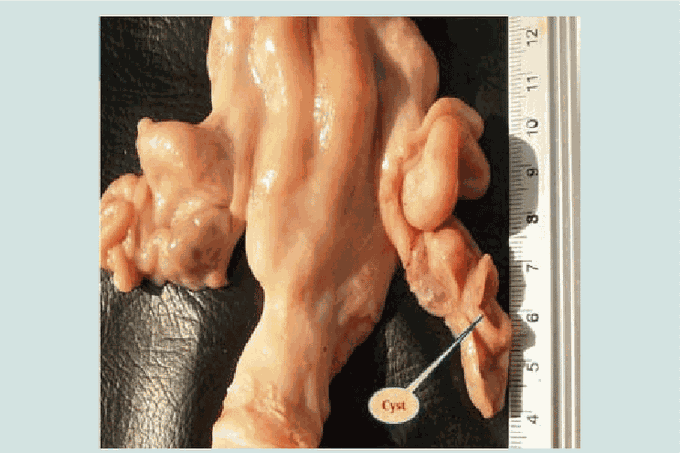 Corpus Luteum Cyst