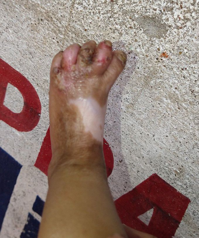 Three months Newborn baby she is suffering from the skin Diseases .What is the name of skin disease and treatment