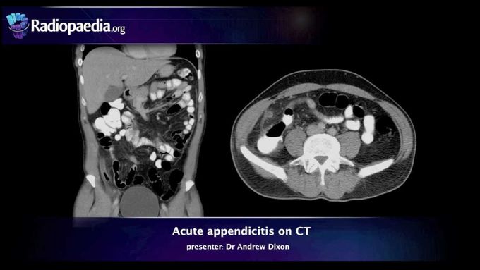 Acute appendicitis on CT - radiology video tutorial