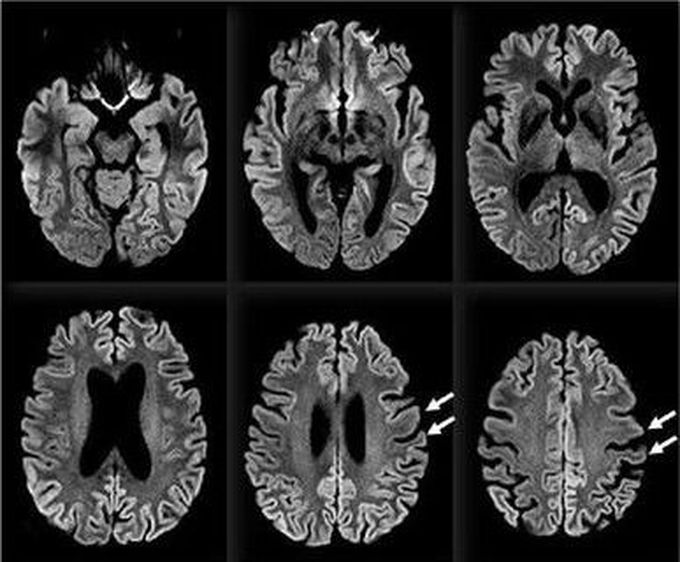 Creutzfeldt Jacob Disease (CJD)