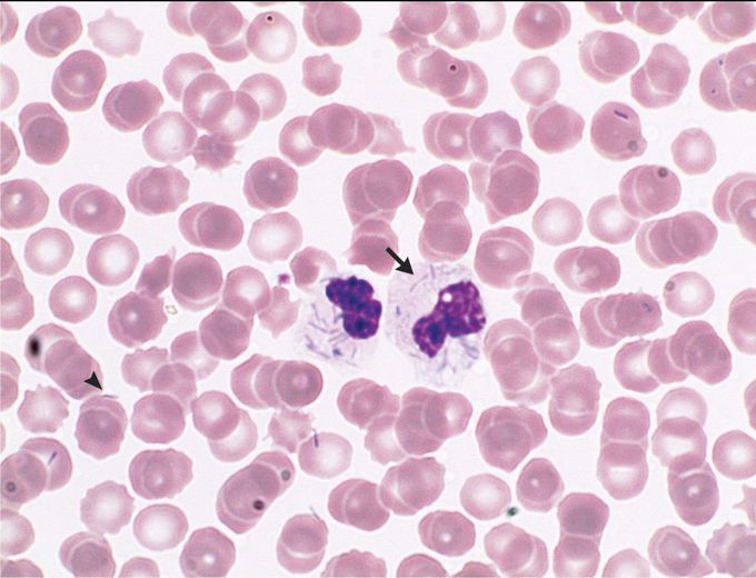 Capnocytophaga canimorsus Infection
