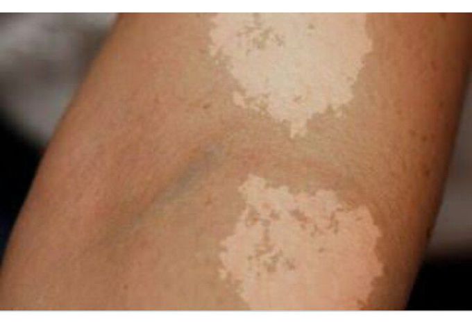 Pityriasis Versicolor