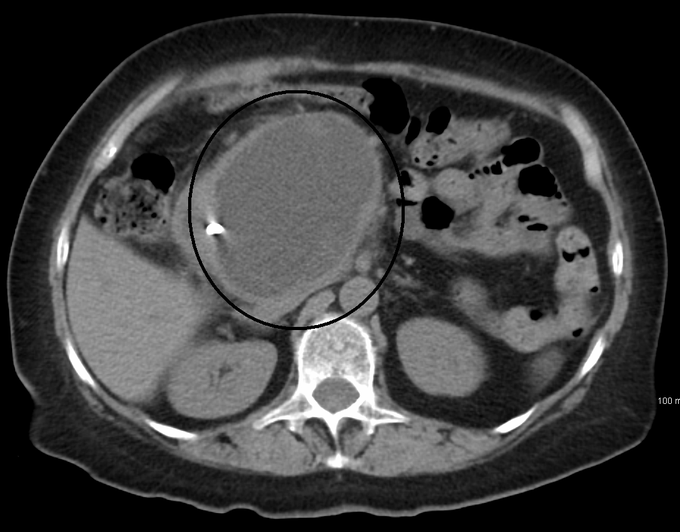 Pancreatic Pseudocyst