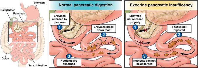 Exocrine Pancreatic Insufficiency