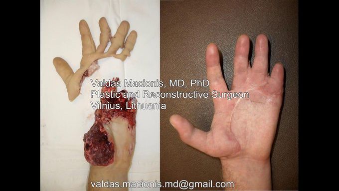 Replantation after amputation of 5 fingers. Hand bone, tendon, nerve, artery & vein repair