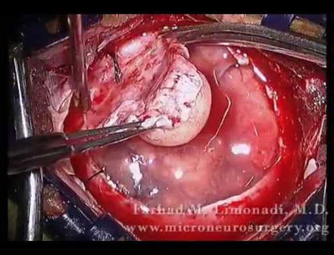 Craniotomy for resection of brain tumor (meningioma).  View through microscope.  Brain surgery.