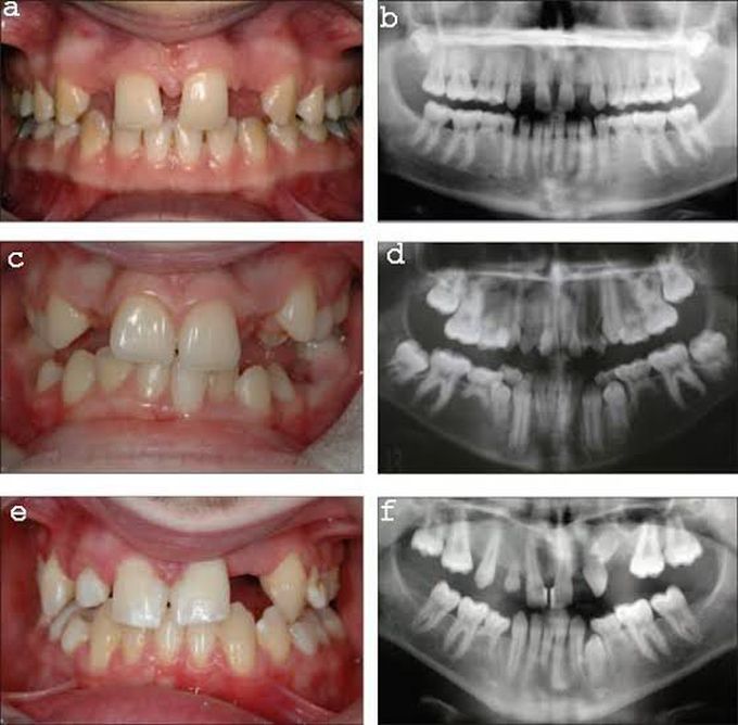 Treatment of hypodontia