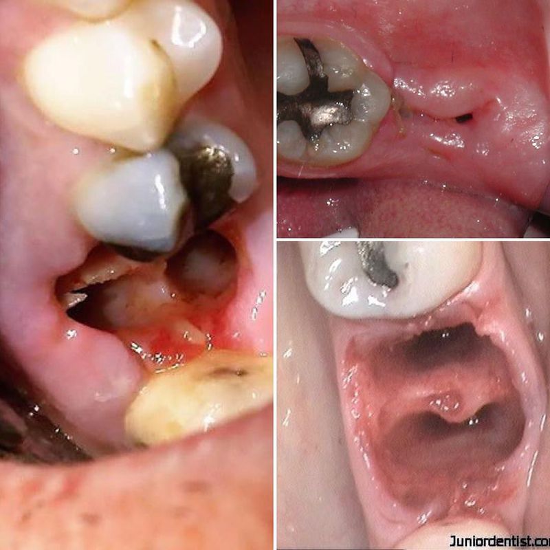 Dry Socket Syndrome: What It Is