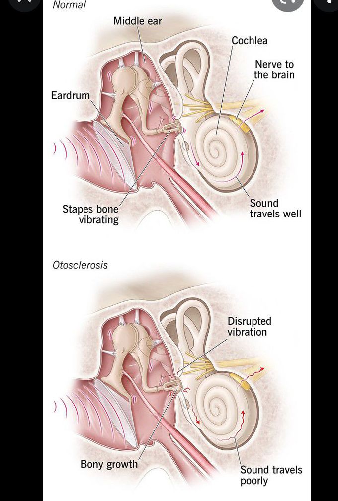 Otosclerosis