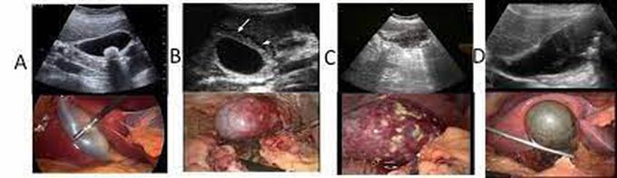 Acute Cholecystitis