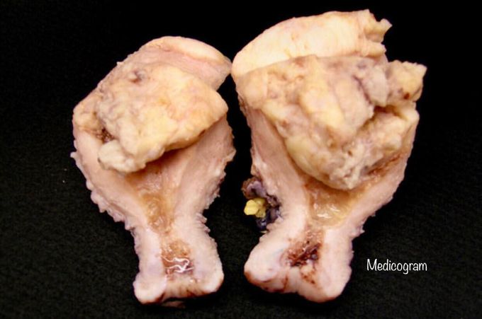 Uterus with carcinosarcoma: 