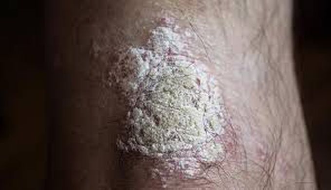 Plaque psoriasis