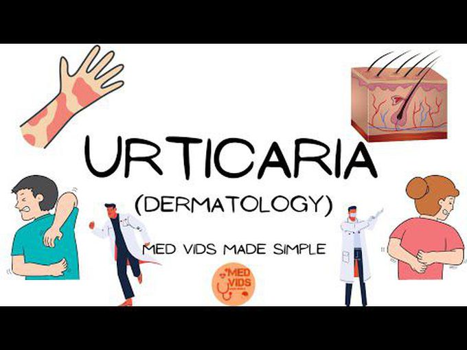 What are hives?- Acute Urticaria