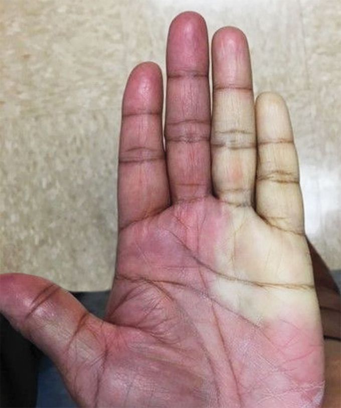 Changing Hand Color after Carpal Tunnel Injection