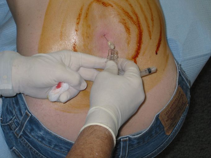 Absolute Contraindications of Lumbar Puncture