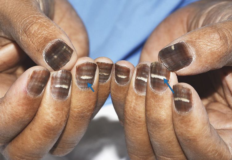 Nail Changes during Chemotherapy MEDizzy