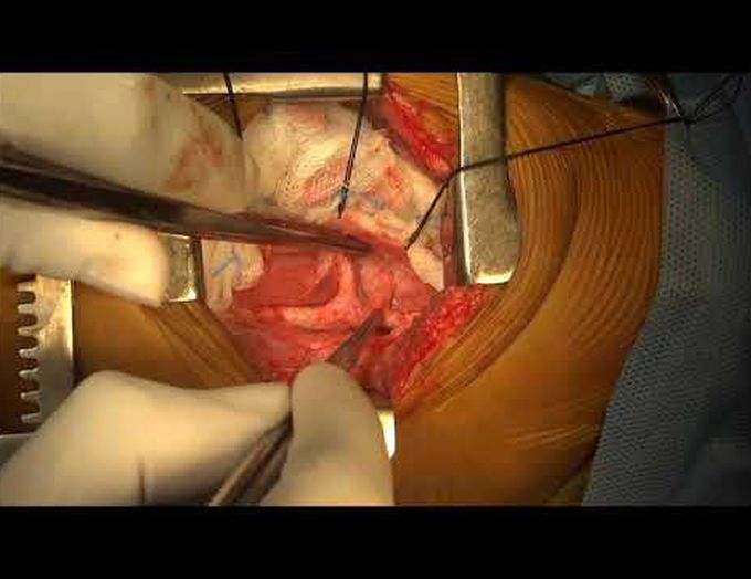 Division of Vascular Ring