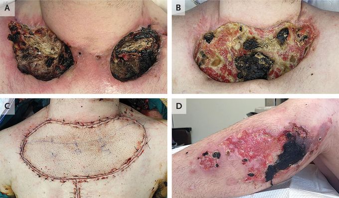 Xylazine-Associated Skin Injury