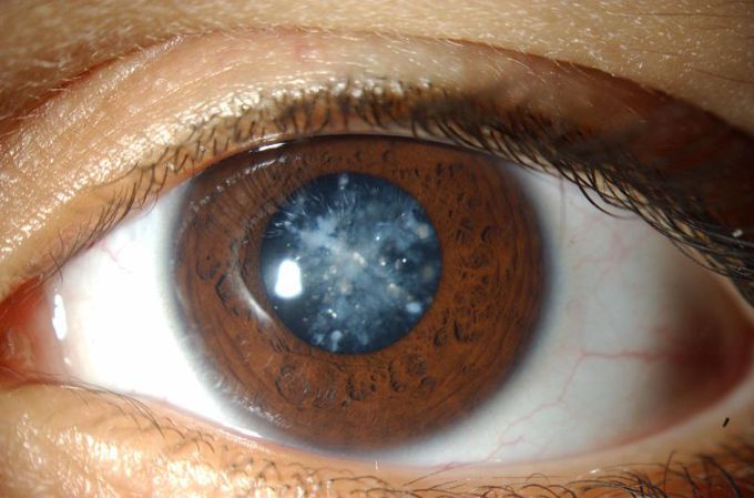 Cerulean/ Blue-dot Cataract