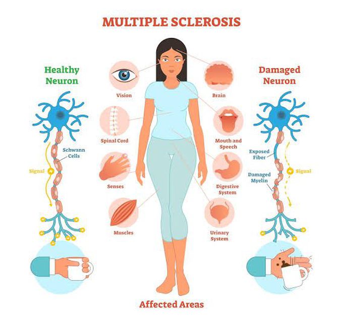 Causes of multiple sclerosis
