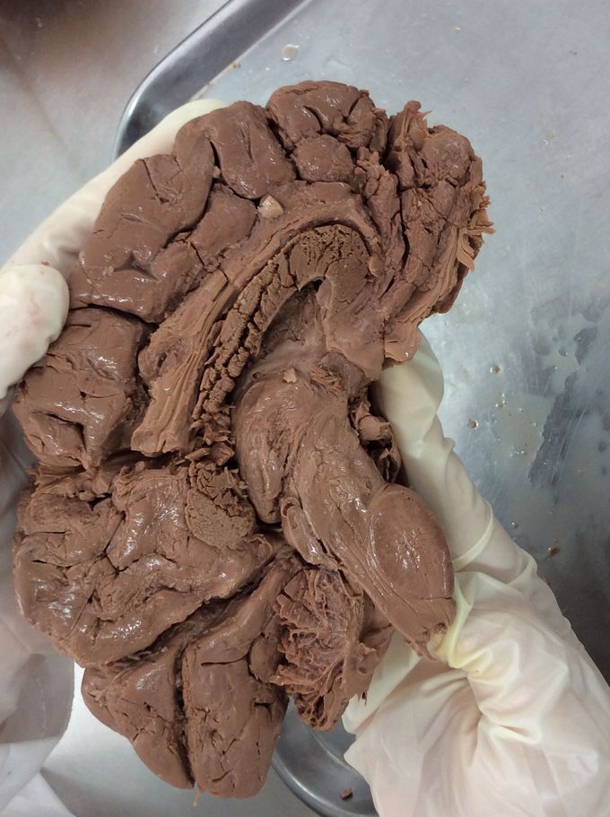 Brain Anatomy – Internal Structures