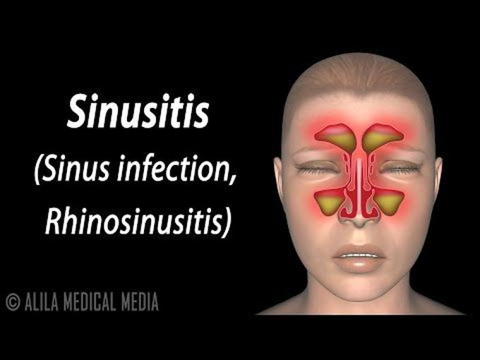 What is Sinusitis? - Animated video