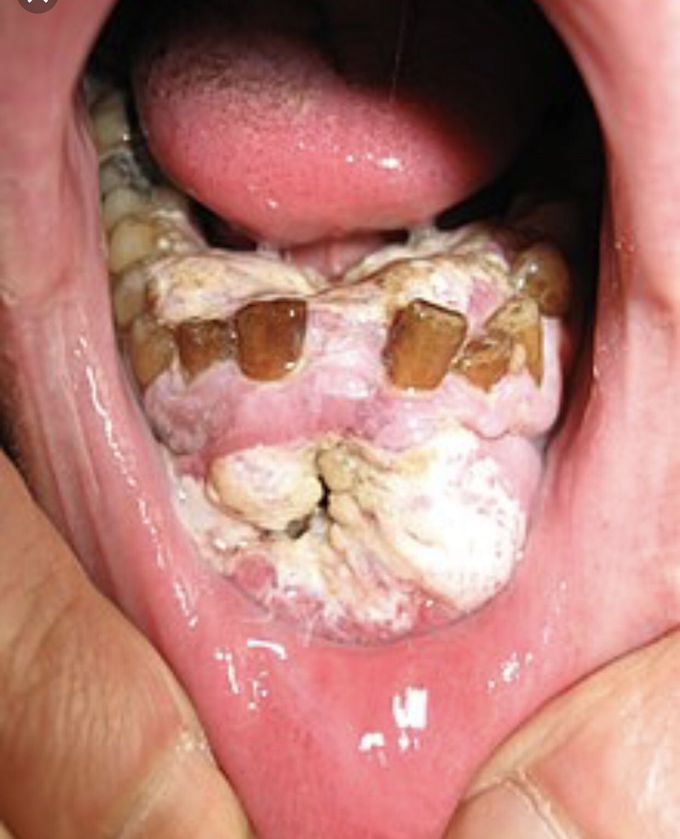 Oral cancer😮😮
