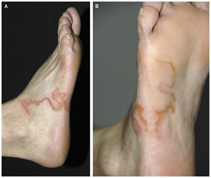 Creeping Eruption — Cutaneous Larva Migrans