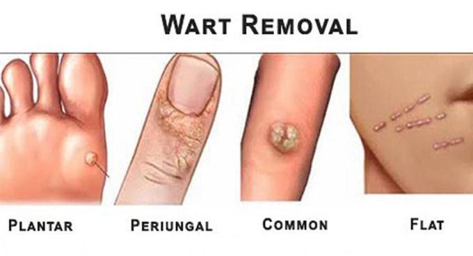 Removal of warts