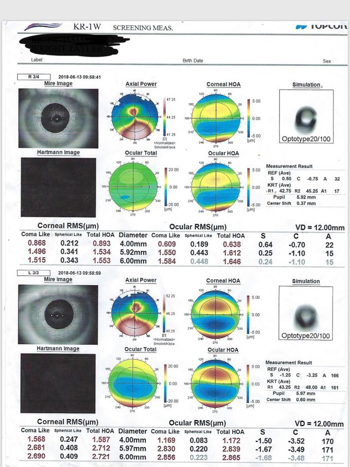 Abnormal Corneal scan of teenage male