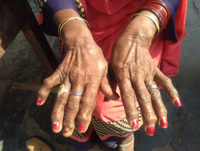 Psoriatic arthritis