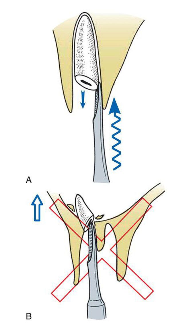 Retrieval of fractured root