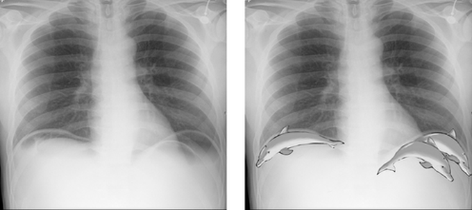 Signs of pneumoperitoneum
