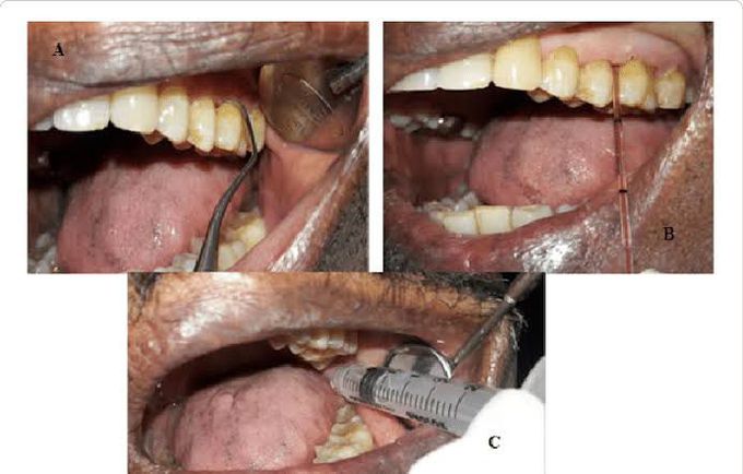 Supragingival plaque