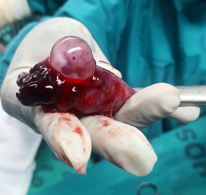 Left Fallopian tube with an ectopic pregnancy in a 25-year-old woman after salpingectomy!