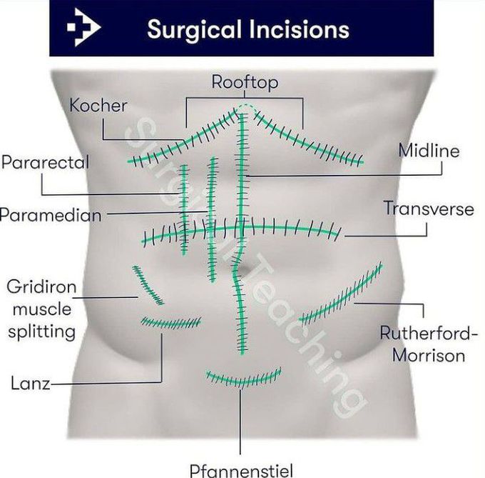 Types of surgical incision