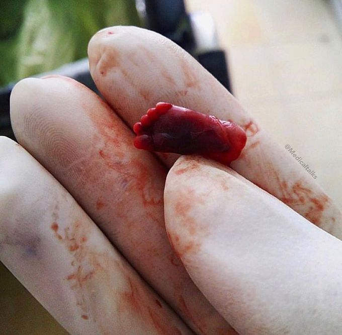This is a tiny little foot of a 14 week old fetus,this was case of a spontaneous miscarriage!