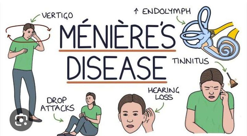Dizziness, vertigo, Meniere's disease, menopause - Stock Illustration  [99435105] - PIXTA