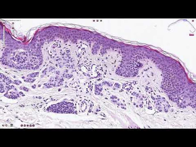 Melanocytic nevus