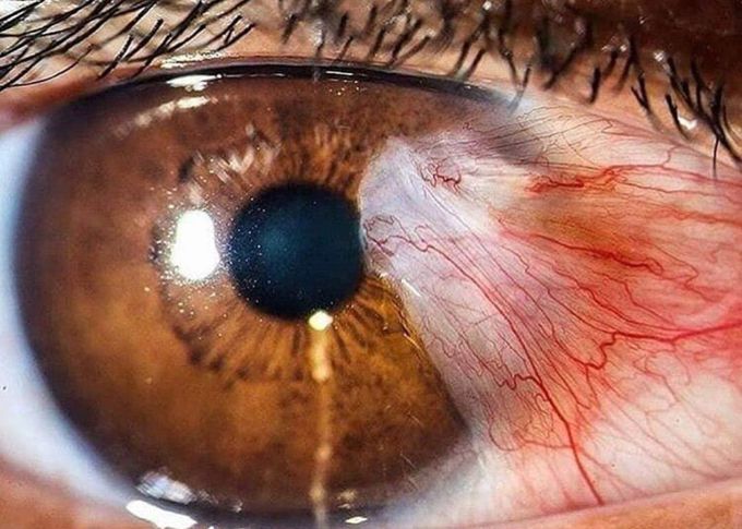 Pterygium