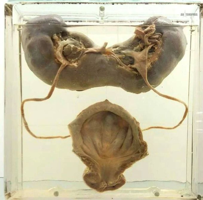 Horseshoe kidney🧲