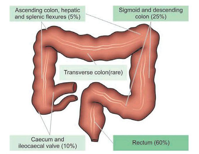 Colorectal cancer