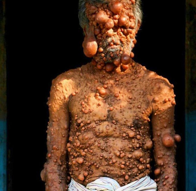 Neurofibromatosis (NF)