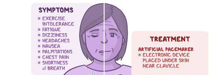 These are the symptoms and treatment of Sick sinus syndrome