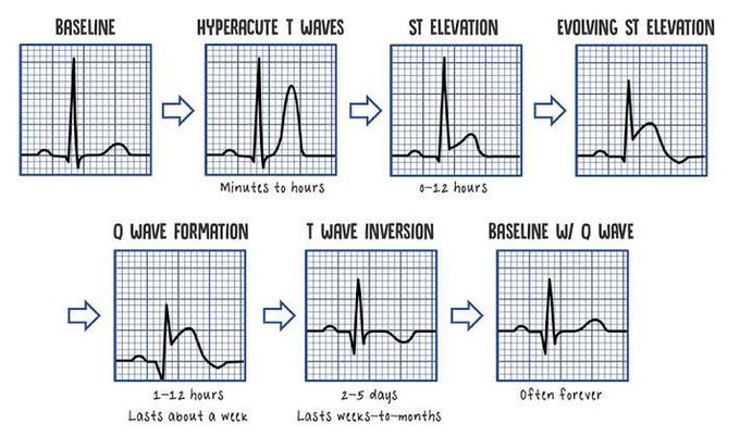 STEMI ECG evolution