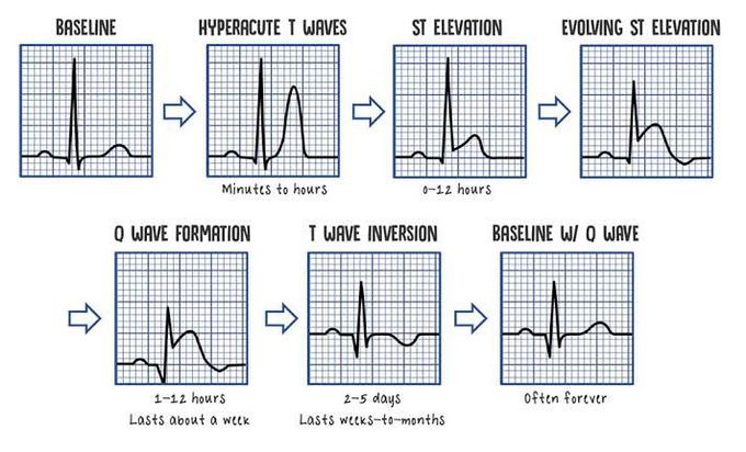 STEMI ECG evolution