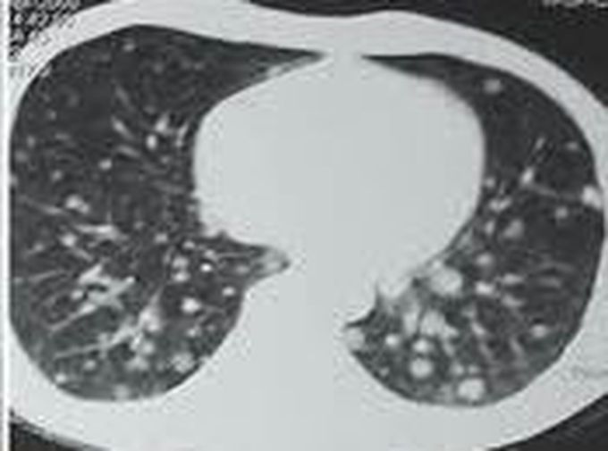 Pulmonary metastasis!